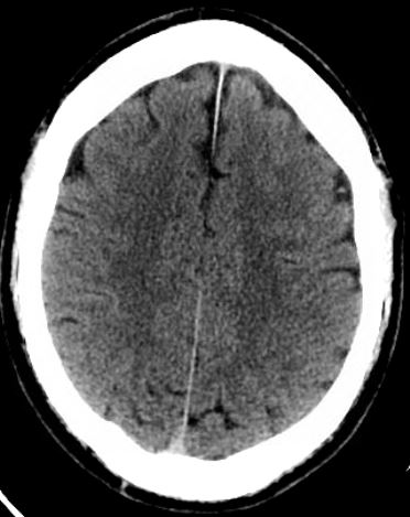 Subarachnoid hemorrhage MRI - Questions and Answers ​in MRI