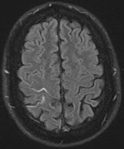 Subarachnoid hemorrhage MRI - Questions and Answers ​in MRI