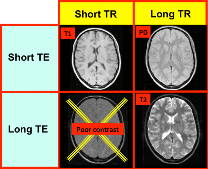 difference-between-t1-and-t2-weighted-mri-images-images-poster