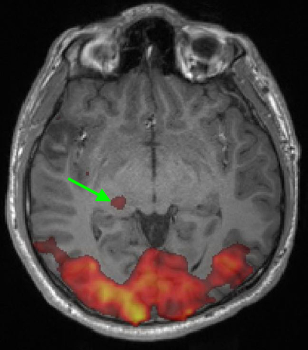 BOLD/fMRI of visual cortex by checkerboard pattern