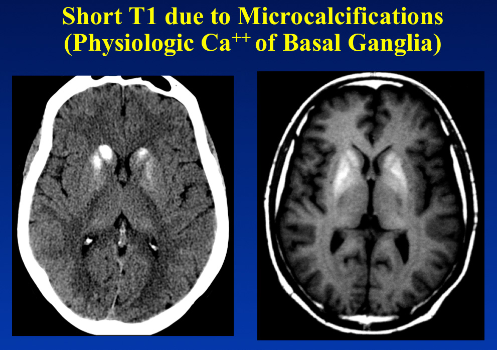 Short T1 calcification - and Answers ​in MRI