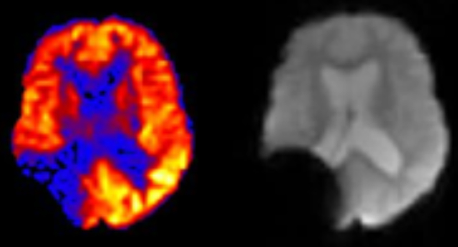 ASL artifacts - Questions and Answers ​in MRI