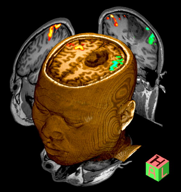 BOLD motor task fMRI activation study