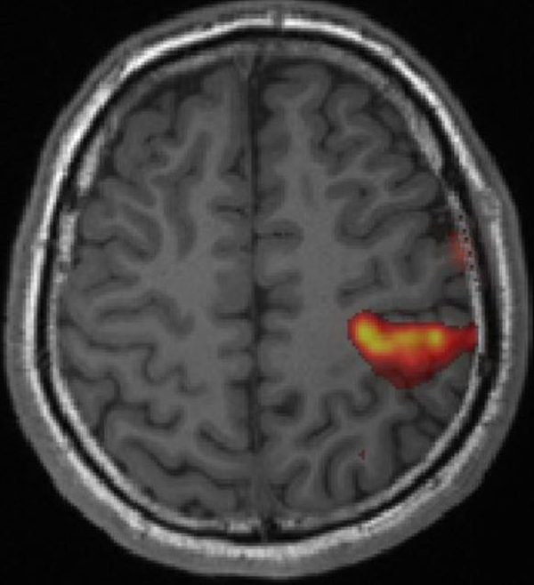 BOLD-fMRI maps of right-sided finger tapping