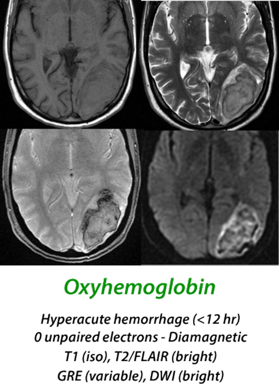 Subarachnoid hemorrhage MRI - Questions and Answers ​in MRI