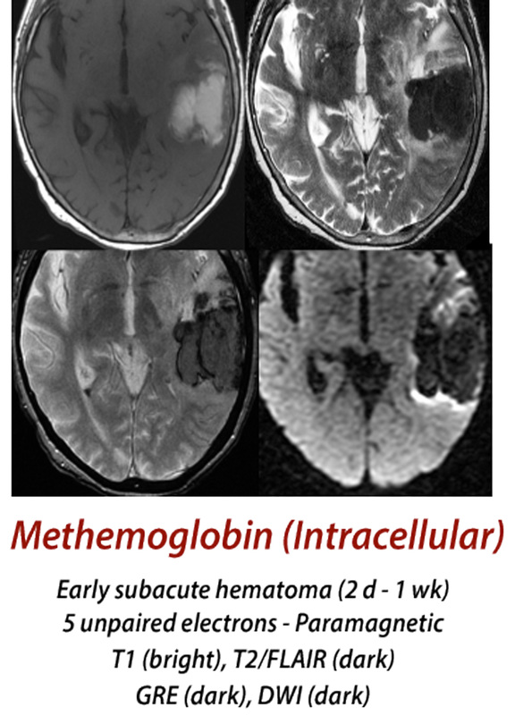 Mri blood weighted t1 MRI interpretation