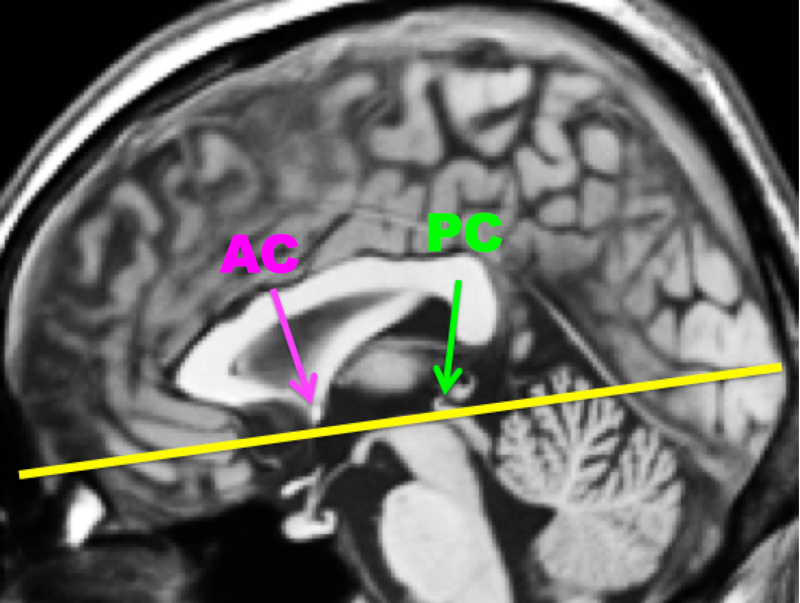 fMRI axial images