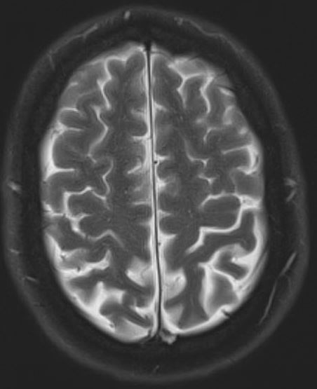 Subarachnoid hemorrhage MRI - Questions and Answers ​in MRI
