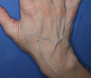 blue veins hand