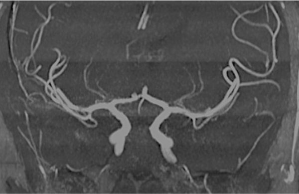 MRA Artifacts TOF Questions And Answers In MRI