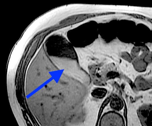 Mandibular nerve - wikidoc