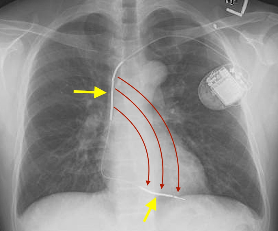Pacemaker terminology - Questions and Answers ​in MRI