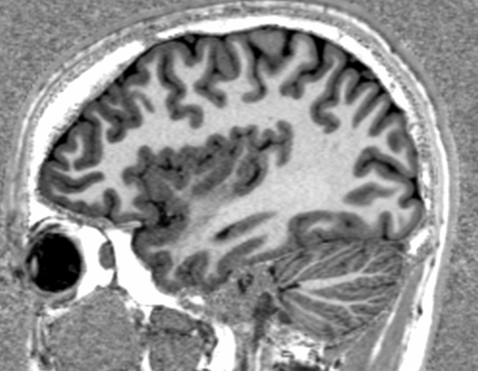 High-resolution 3D T1-weighted turbo fi eld echo imaging of the brain.