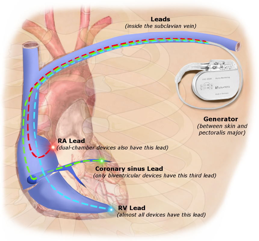 implantable cardioverter defibrillator vs pacemaker