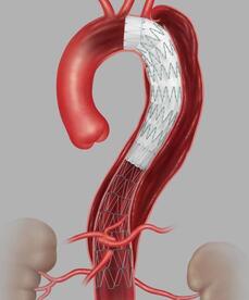 aortic stent graft