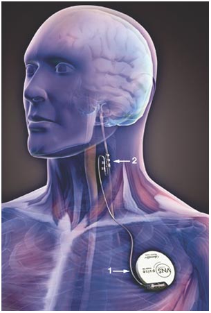 nerve stimulator implant