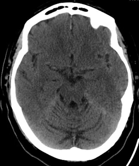 subarachnoid hemorrhage mri