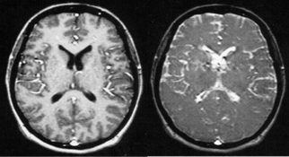 MRI spoiling GRE images brain