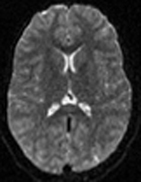 Diffusion MRI b-value