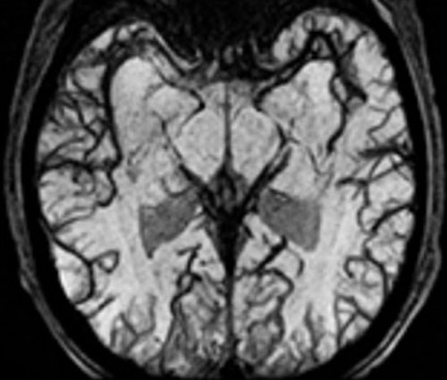 Color of blood - Questions and Answers ​in MRI