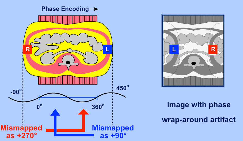 Wrap-around artifact - Questions and Answers ​in MRI