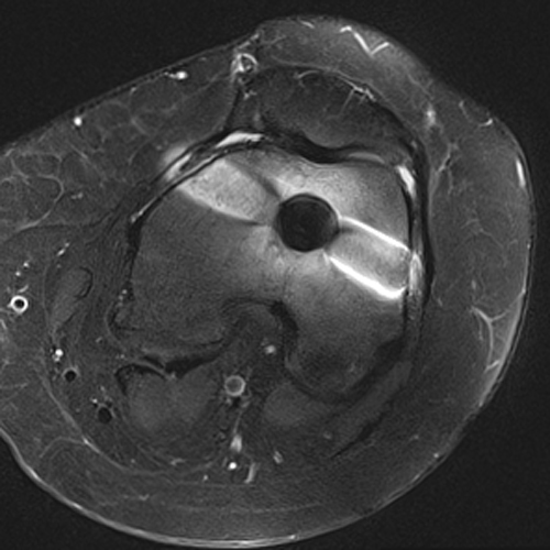 Wrap-around artifact - Questions and Answers ​in MRI