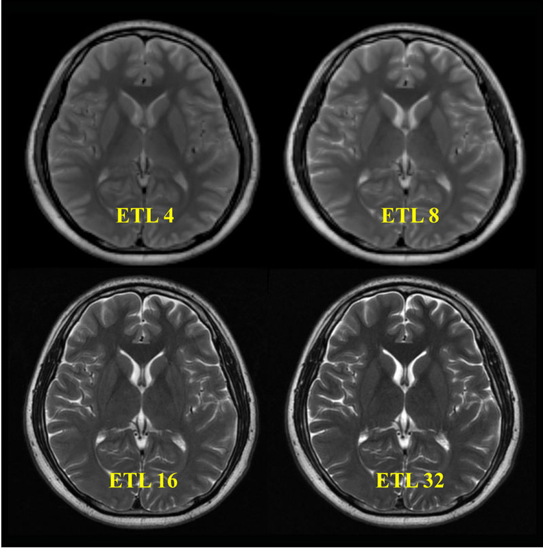 High-resolution 3D T1-weighted turbo fi eld echo imaging of the brain.