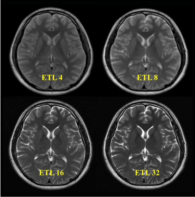 fse-parameters-questions-and-answers-in-mri