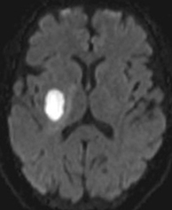 Causes of restricted diffusion MRI: abscess