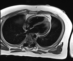 Bone stimulators - Questions and Answers ​in MRI