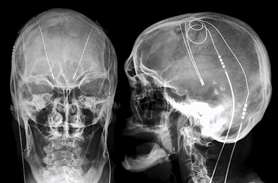Deep brain stimulators - Questions and Answers in MRI