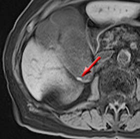 Pigment gallstone MRI T1 short