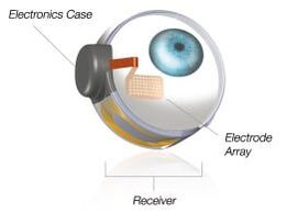 Argus II Retinal Prosthesis