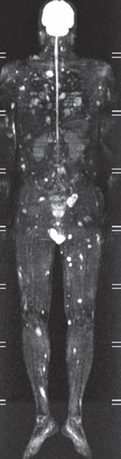 diffusion-weighted whole-body imaging with background body signal suppression (DWIBS)