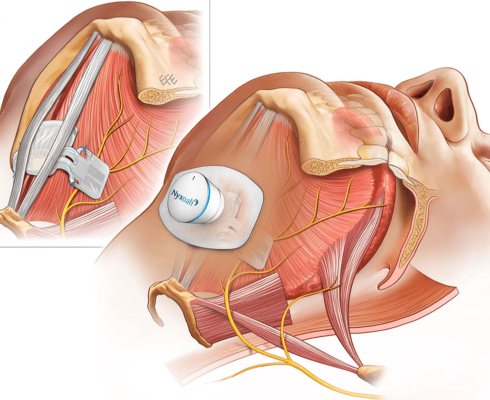 Image 09303: Cervical Nerve Stimulator Device Placement Surgery Illustration