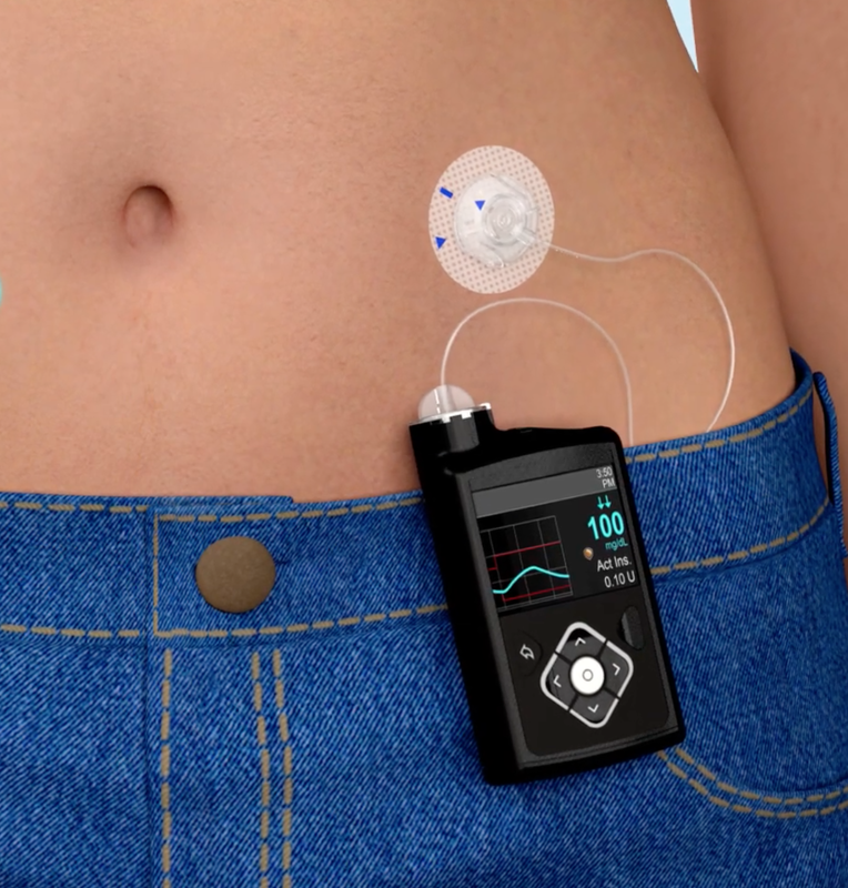 tag et billede uformel stramt Insulin pumps, glucose meters - Questions and Answers ​in MRI