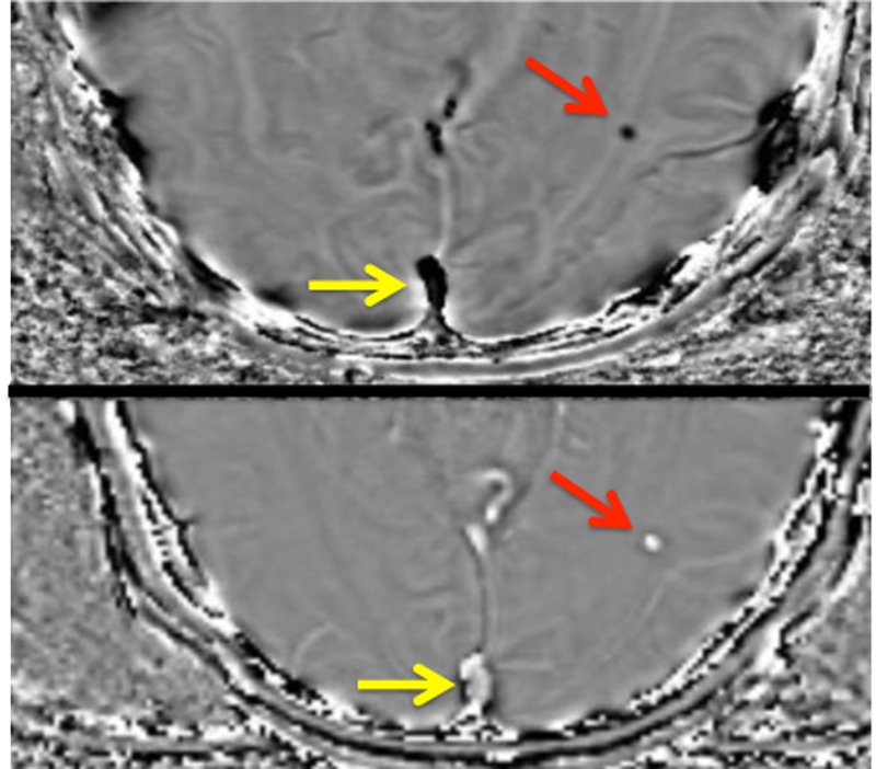 susceptibility-phase-questions-and-answers-in-mri