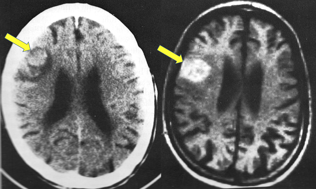 Hemorrhage at low - Questions Answers ​in MRI