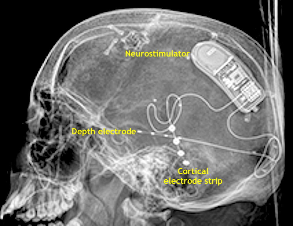 Cranial electrodes? - Questions and Answers in MRI