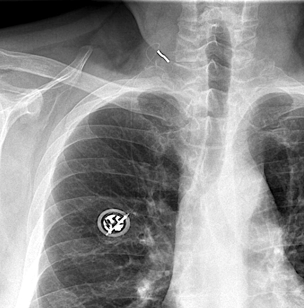 MR Safety: Respiratory Stimulators - Questions and Answers ​in MRI