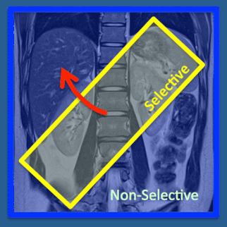 MRA with arterial spin labeling (ASL)
