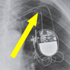 Fractured pacemaker lead