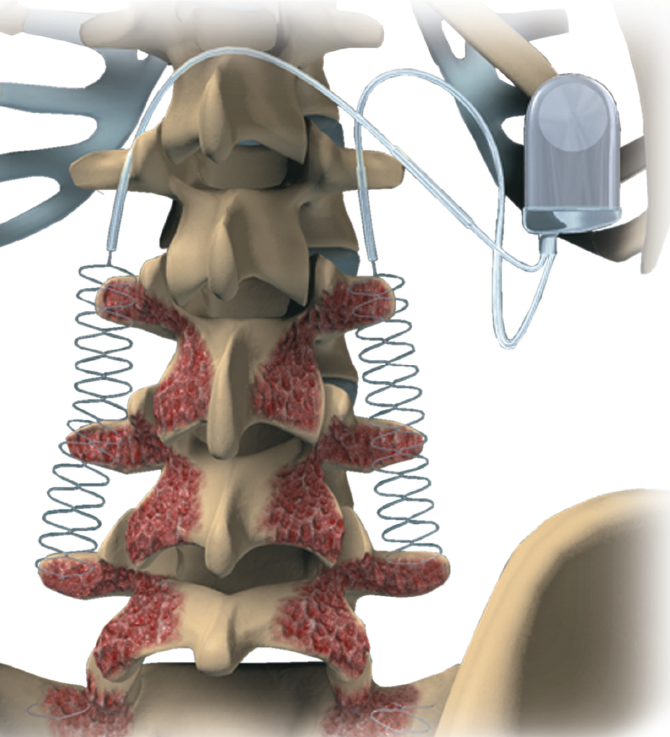Ultrasound Bone Stimulator Accelerates Clinical and Radiographic