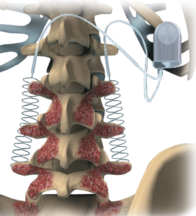 Self-powered implantable device stimulates fast bone healing, then